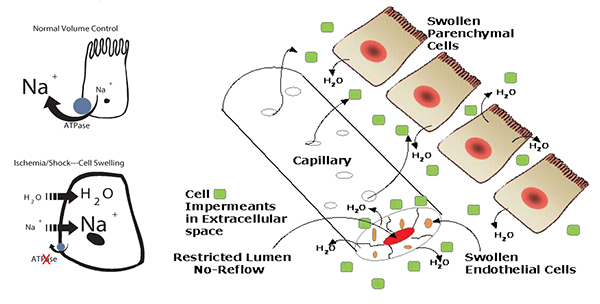 Graphic showing swollen endothelial and parenchymal cells in a capillary with restricted lumen