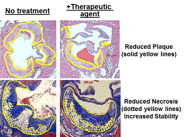 Pictures showing no treatment versus therapeutic agent reducing plaque and necrosis